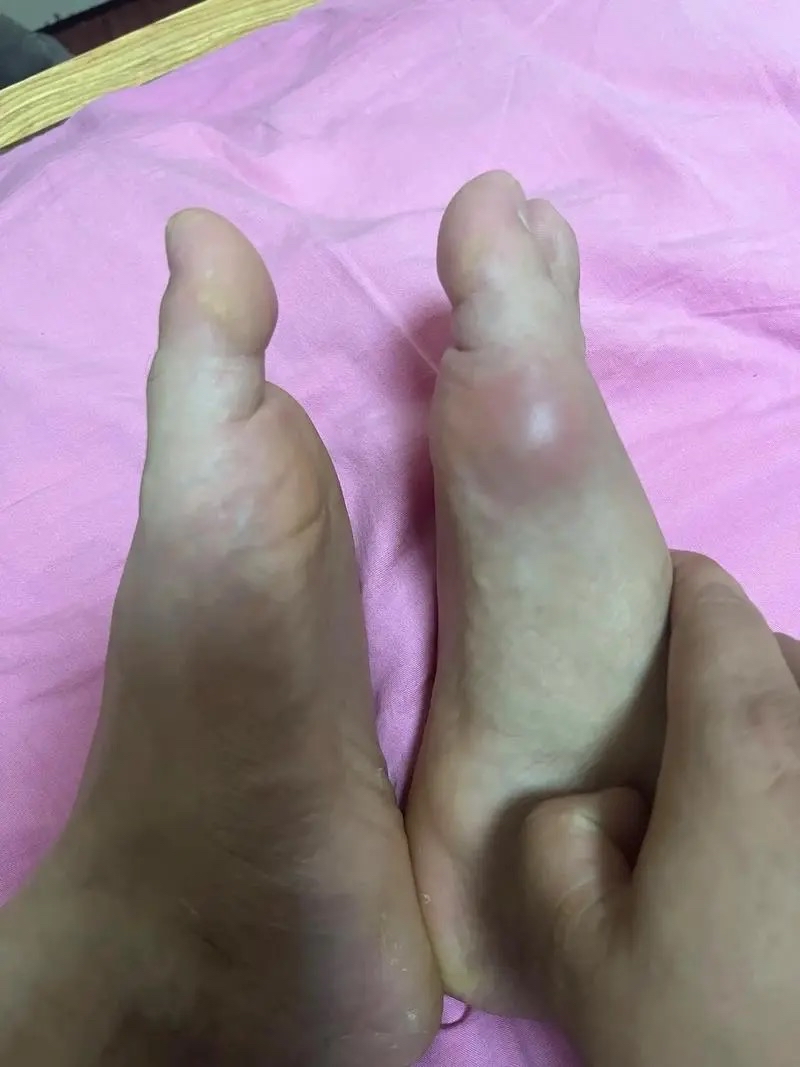 许多年轻人出现了尿酸的升高,其中只有大约百分之一的人会出现痛风