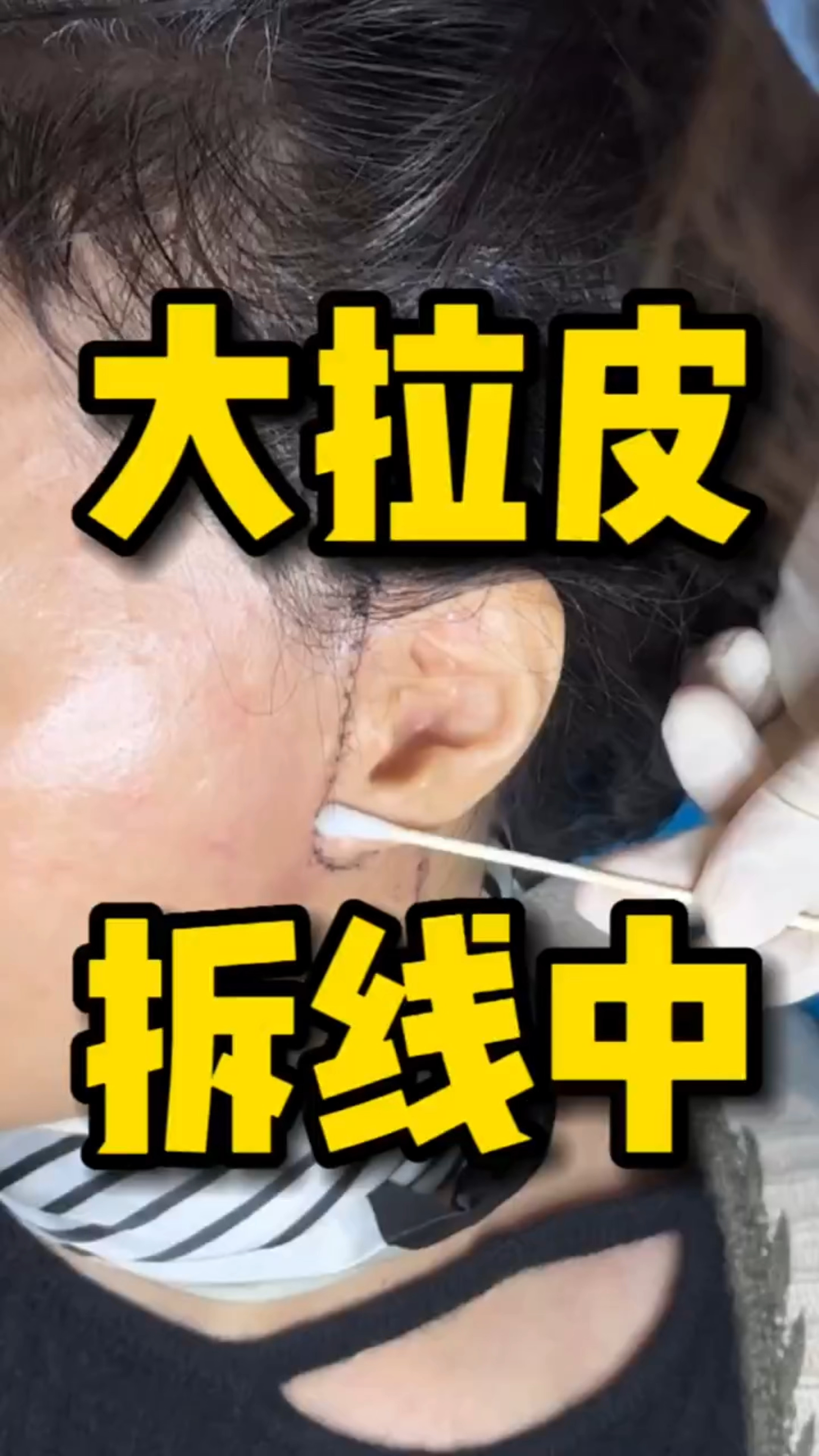 大拉皮术后第十天拆线中