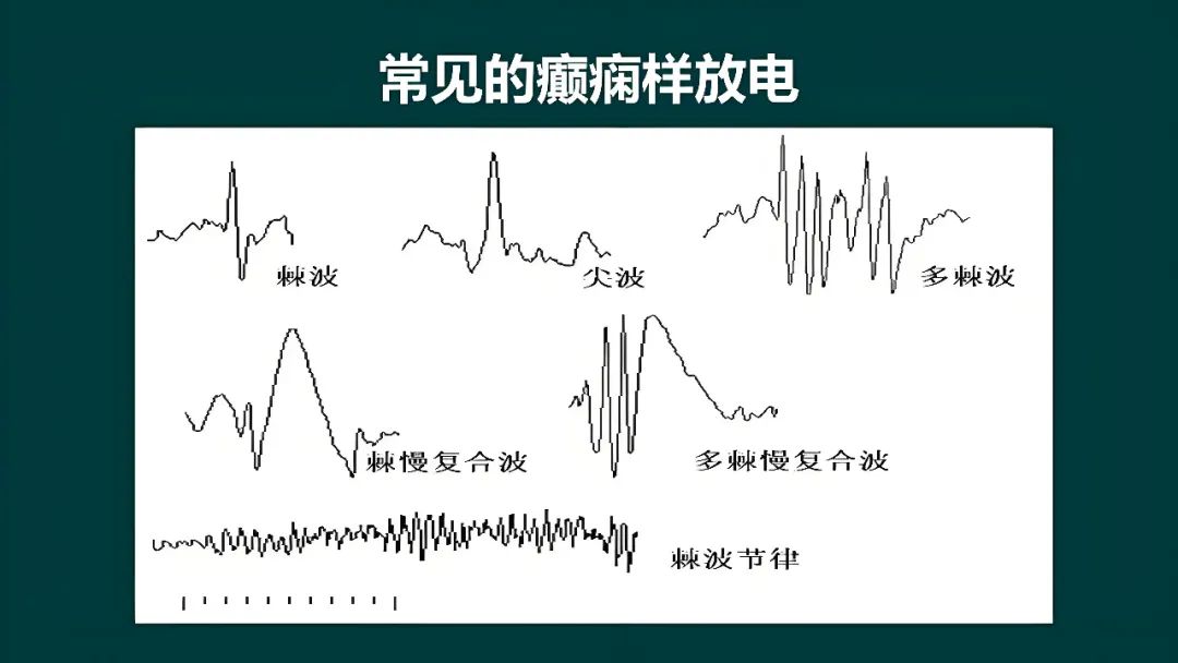 异常脑电图尖波尖慢波图片