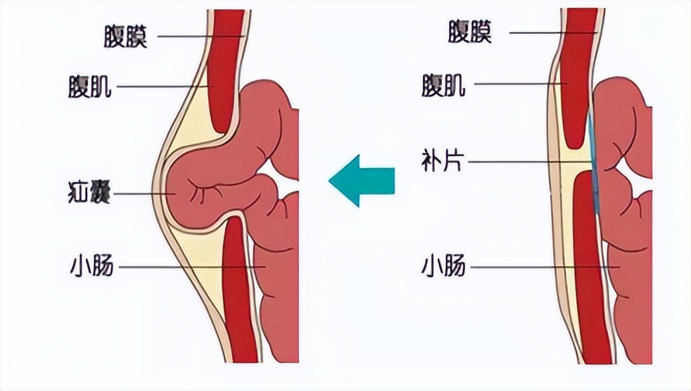 疝气疼的位置图片图片