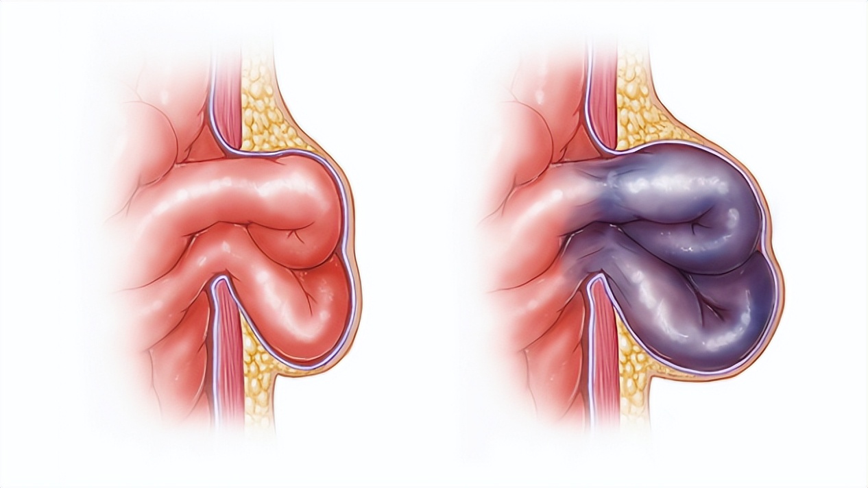 疝气疼的位置图片图片