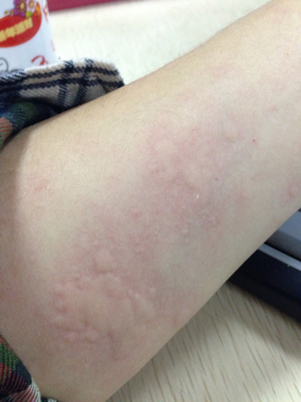 荨麻疹常见5种表现形式,但愿你只是第一种!  1.