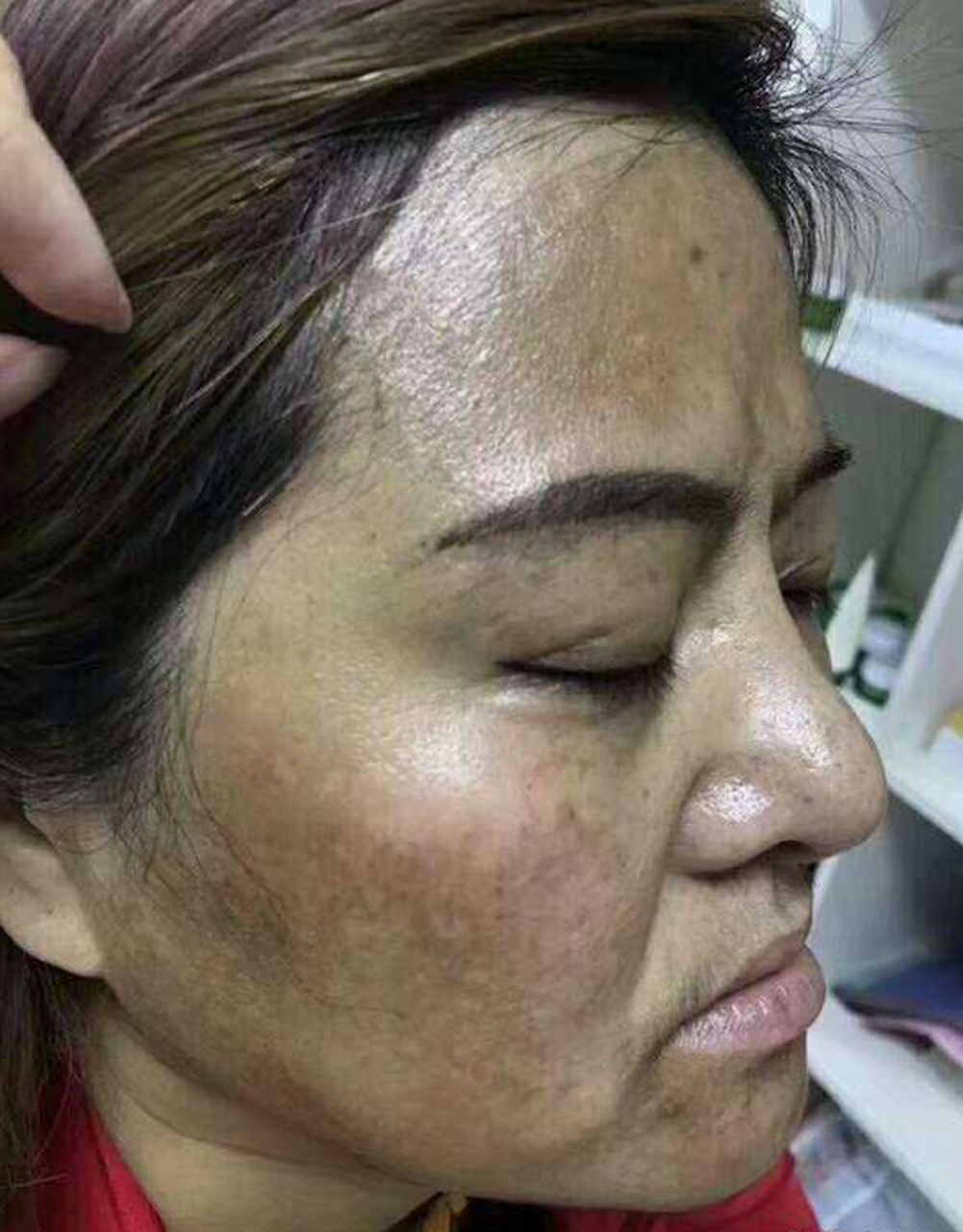 你可曾听闻——颧骨长斑,其因在肝!