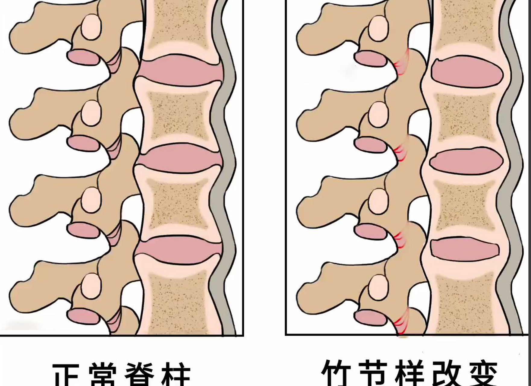 强直性脊柱炎位置图片