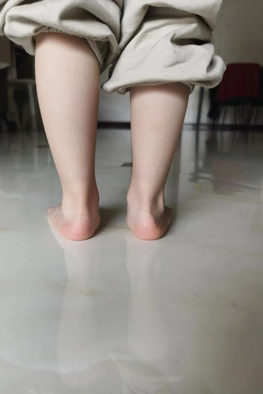 足外翻的小孩,如果家长不会观察,可以直接看他小腿后侧中线和脚后跟的