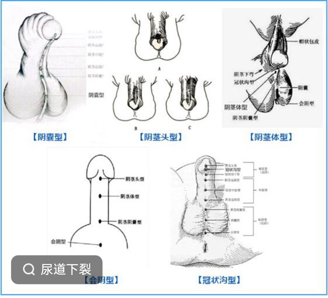 尿道下裂阴囊型图片