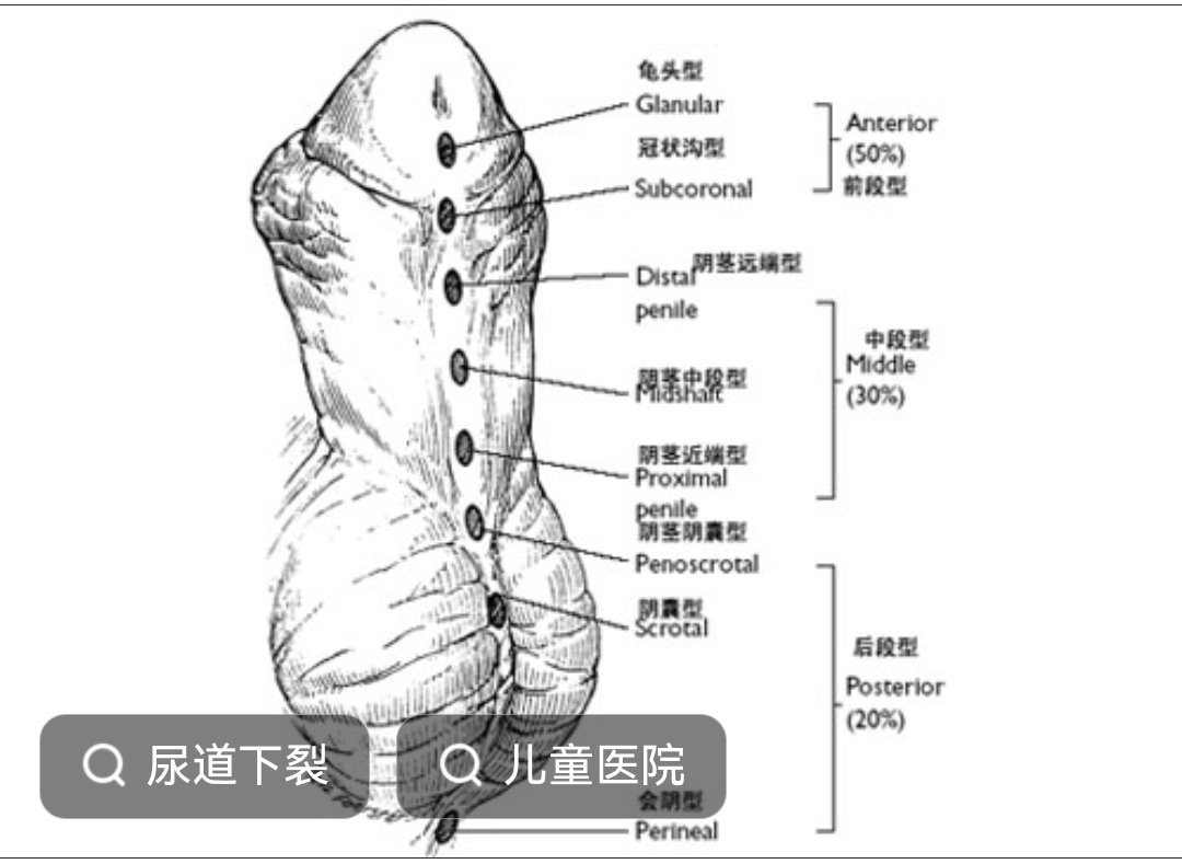 尿道下裂是母亲的原因图片