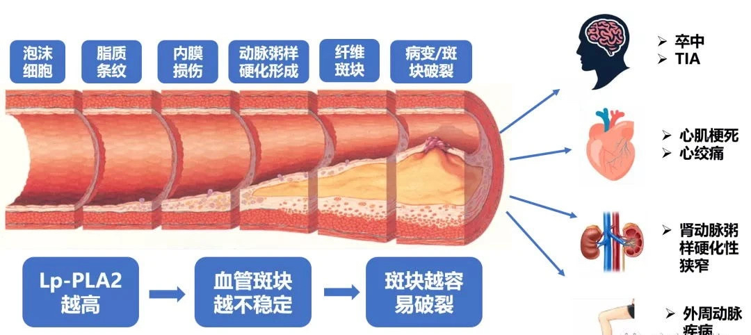 lp—pla2(lppla2值900多怎么治疗)