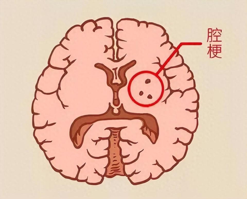 脑梗塞部位及症状图片图片