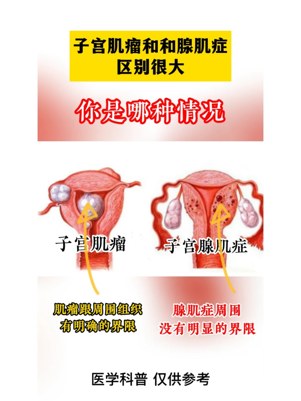 子宫腺肌症图片