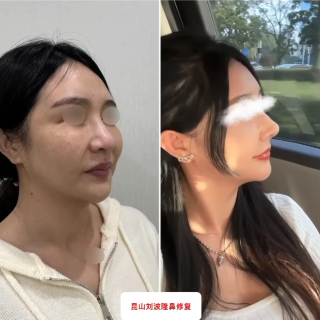 全肋软骨隆鼻修复术后4个月,主要是鼻头精致一点,鼻尖翘一点,山根尽量