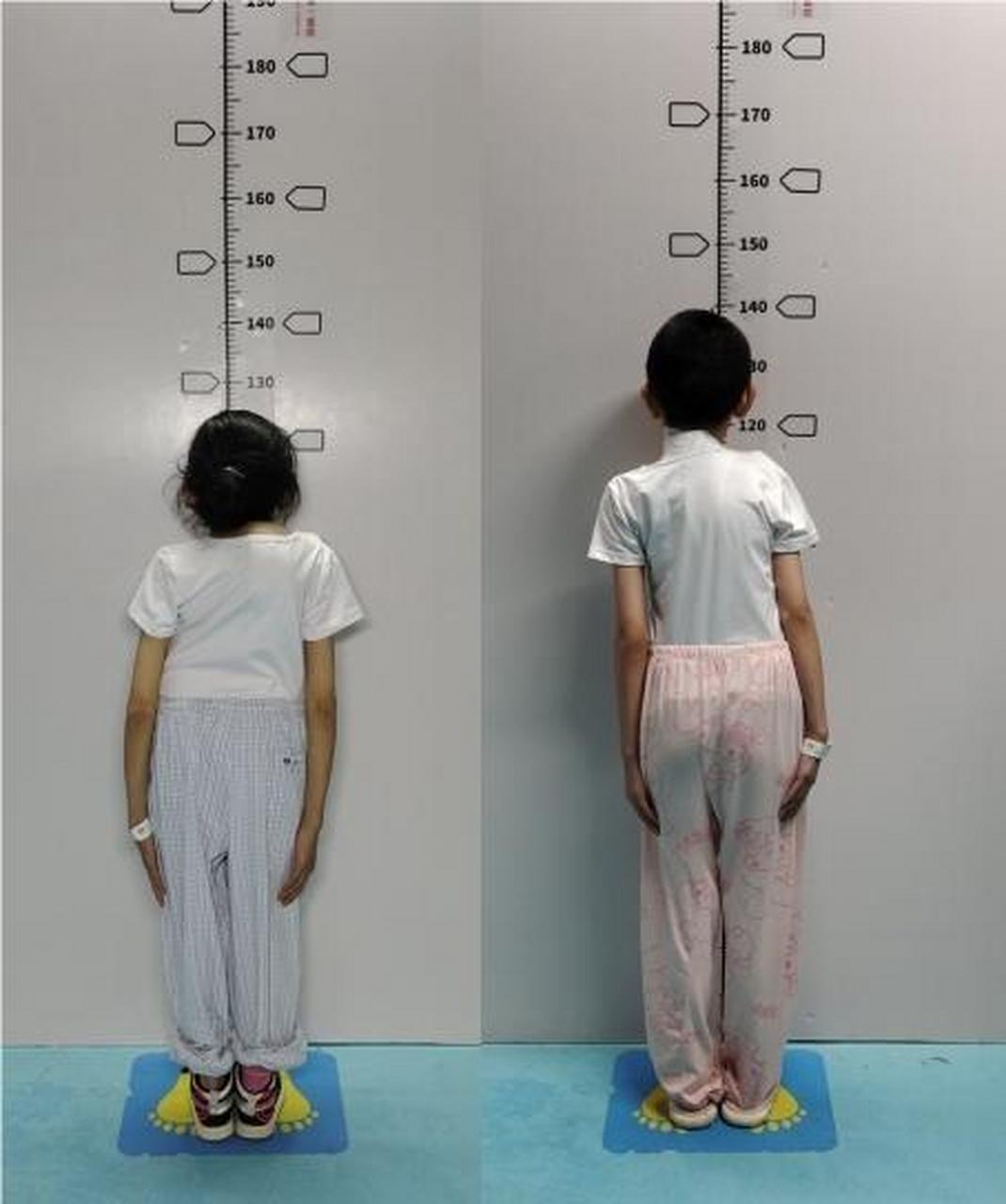 这位19岁的藏族女孩,身高仅1米2,属于先天性脊柱侧弯重度患者.