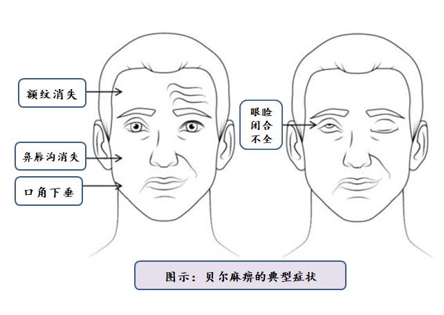 ,又称"原因不明的急性面瘫",是一种常见的颅