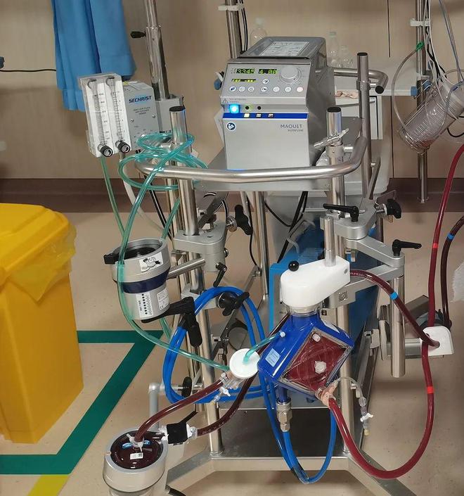 男子心脏停跳152分钟被救活# ecmo,这个被誉为"救命神器"的体外膜 