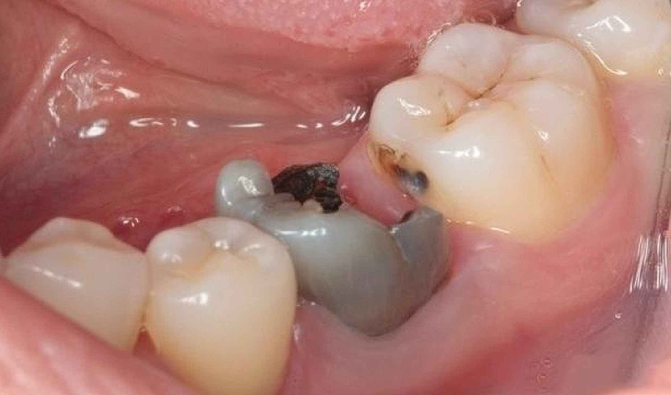 作为口腔医生我认为很有必要出一期关于"虫牙"的科普知识.