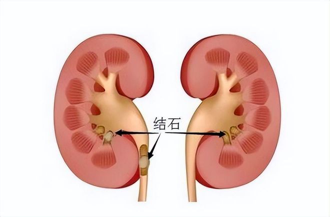 体检查出肾结石怎么办?提醒 4个方法