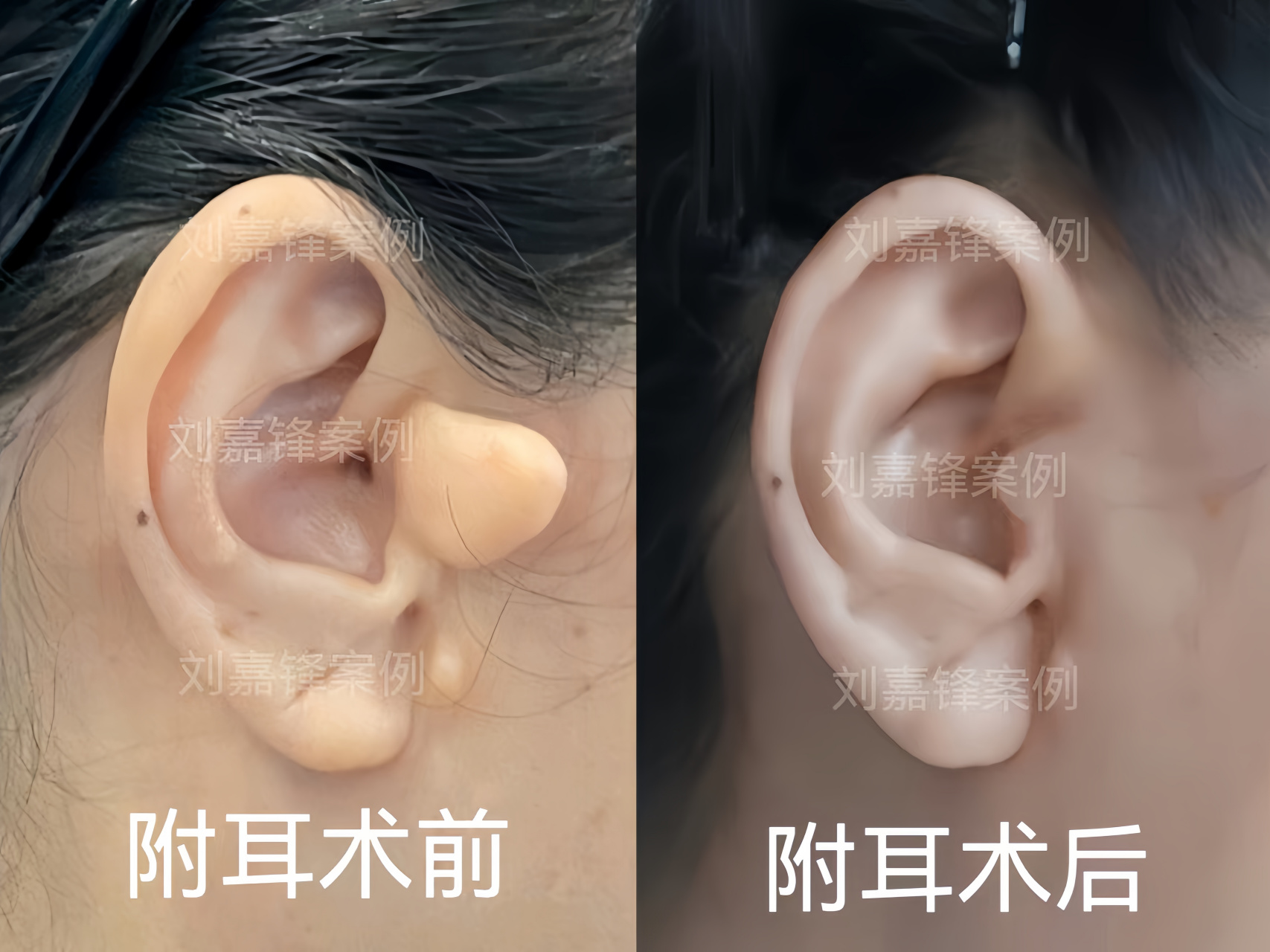 想要切除附耳,这样的时间安排简直完美!