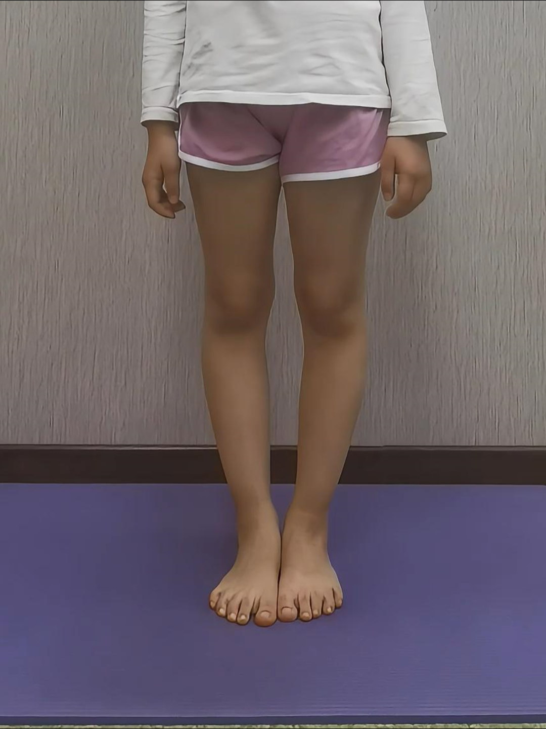 新生儿胫骨平台本应平坦,但罗圈腿使小腿相对于大腿向内有一个倾斜