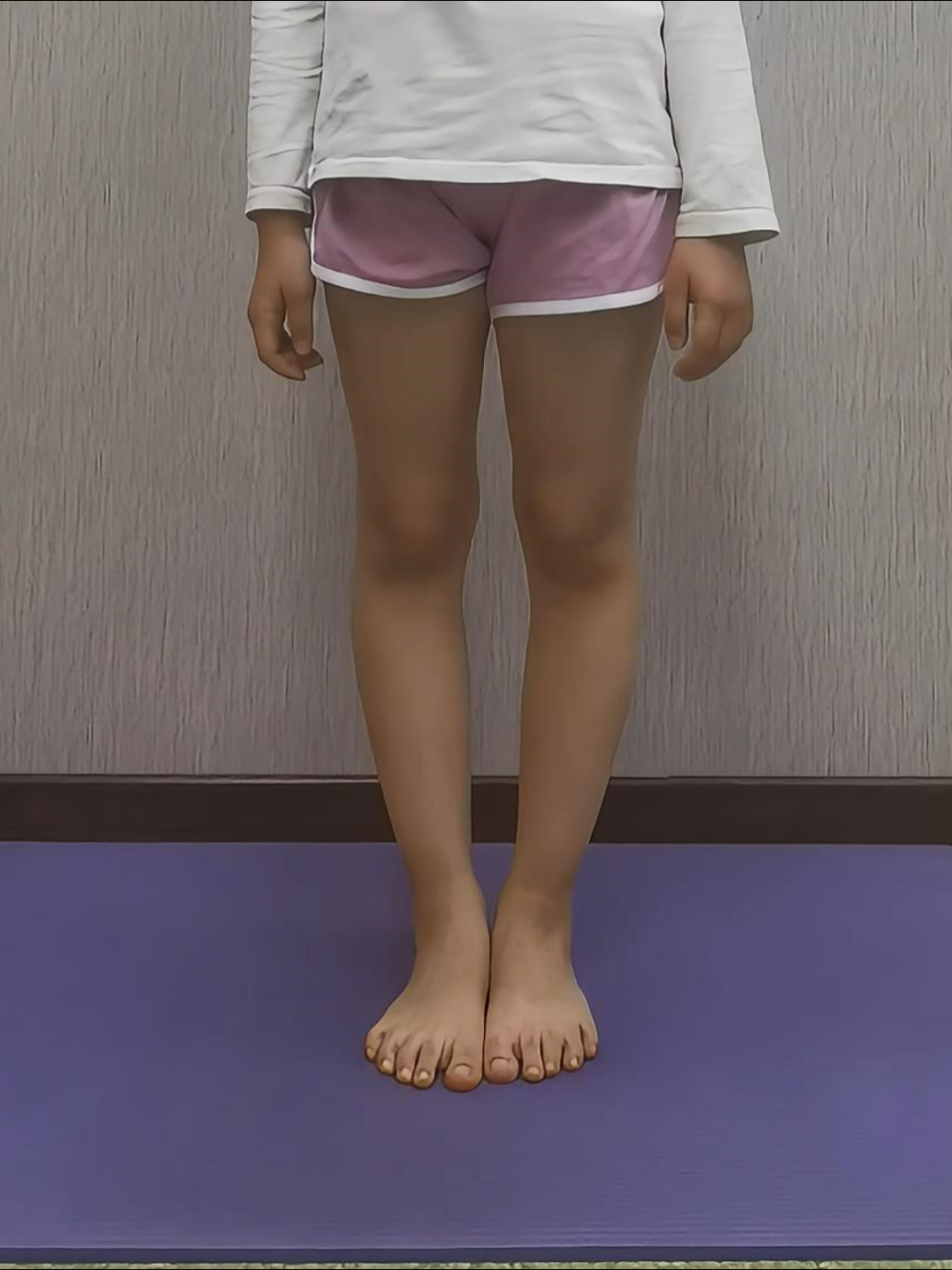 随着孩子快速生长,内侧承受更多压力,生长受限;外侧则正常生长.