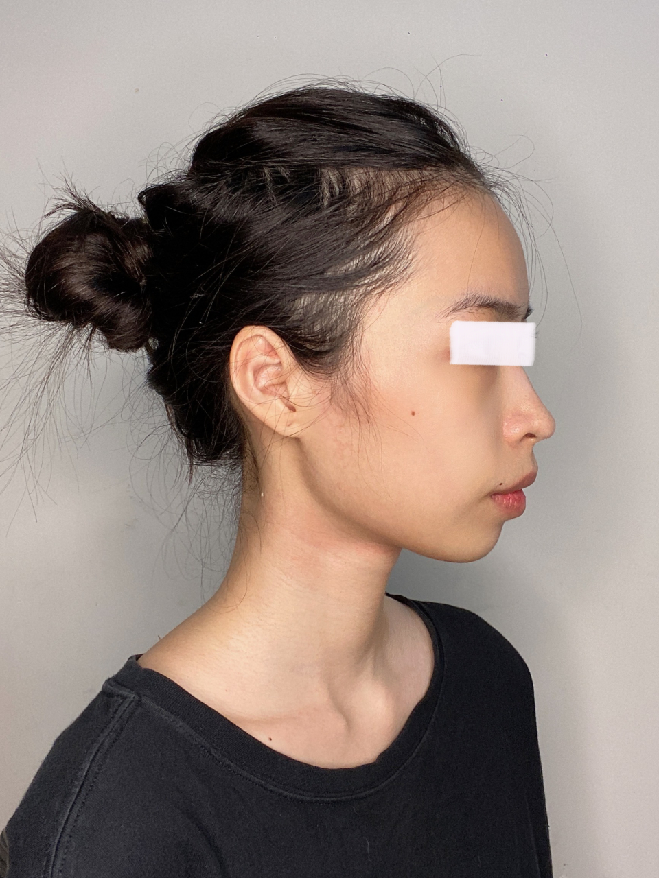 男朋友说没有效果  我的五官其实还算精致,就是下颌角太突出,从侧面看