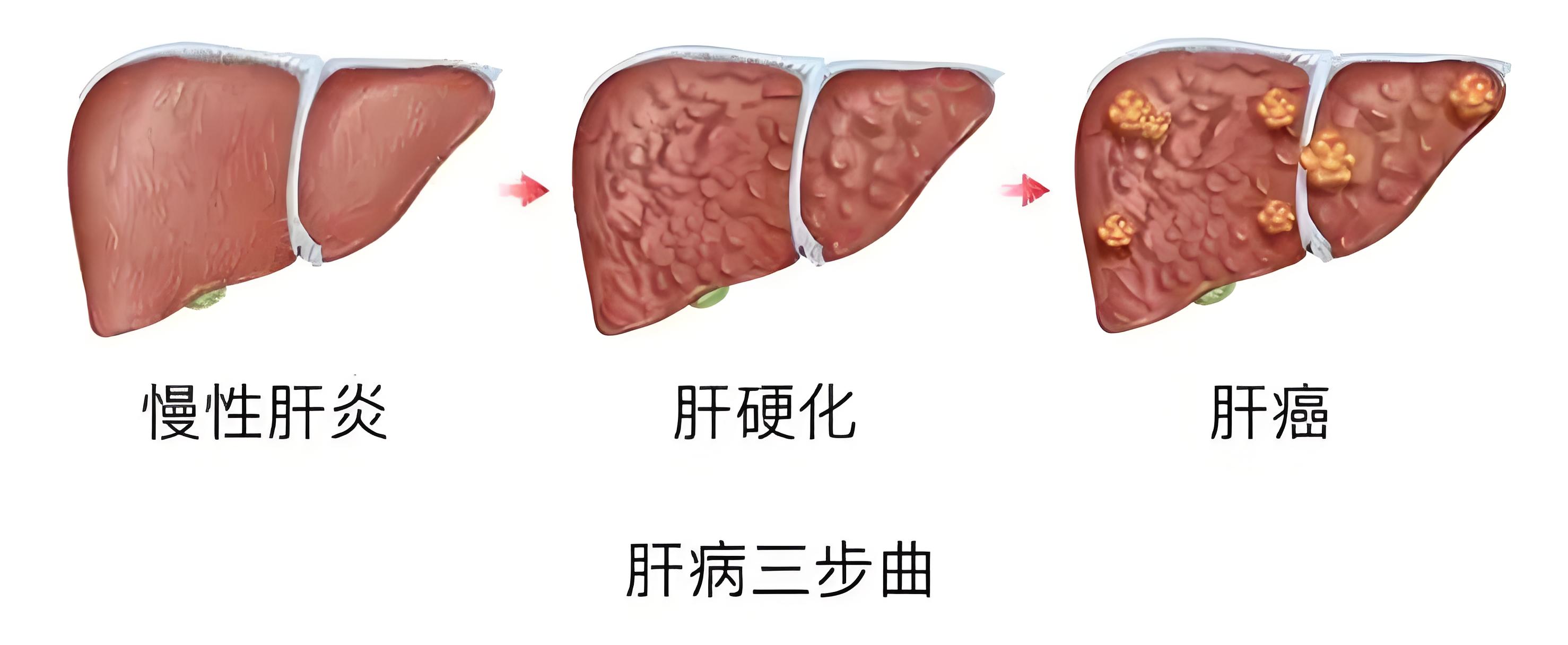 肝硬化患者如果出现这5种症状,你真的不能再拖了!