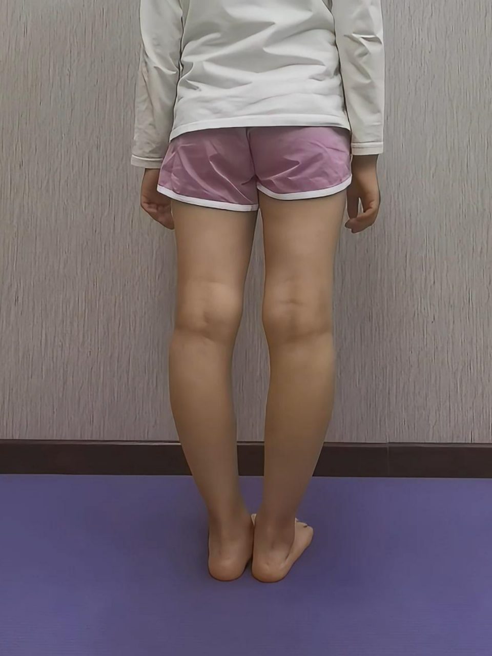 随着孩子快速生长,内侧承受更多压力,生长受限;外侧则正常生长.