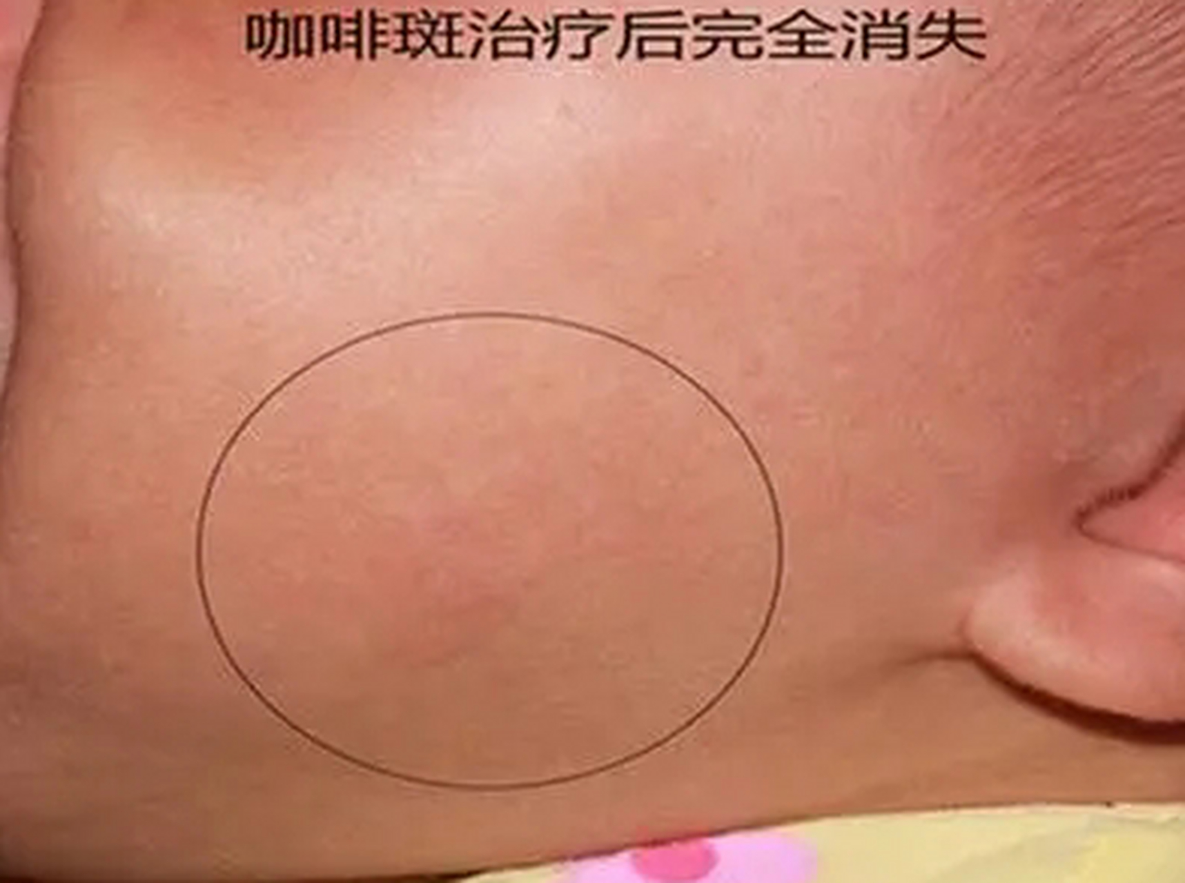 如果身上有超过6处的咖啡斑,而且直径在1.