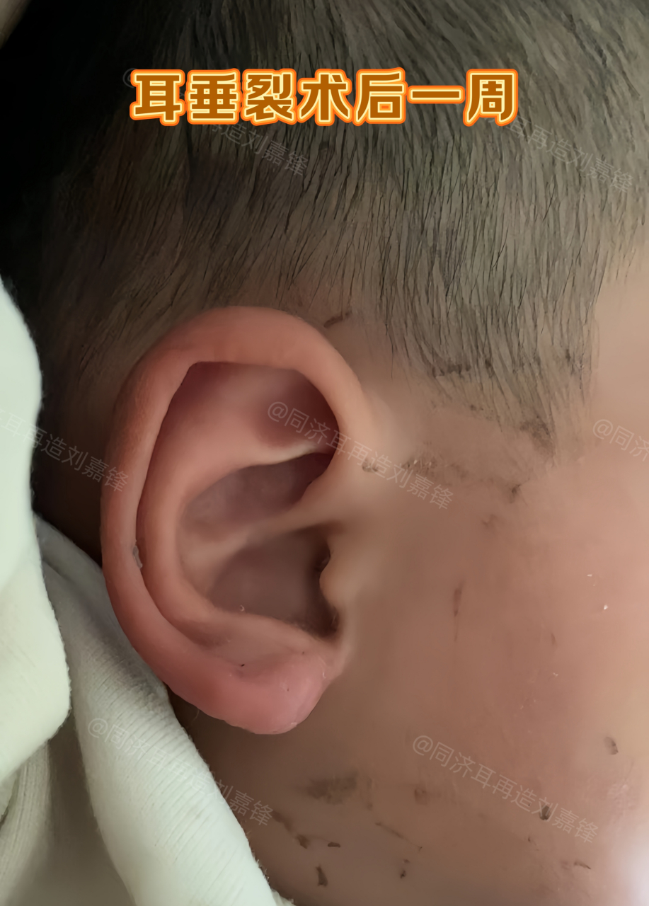 宝宝耳垂连起来了,妈妈说再也不会有人给他取外号了.