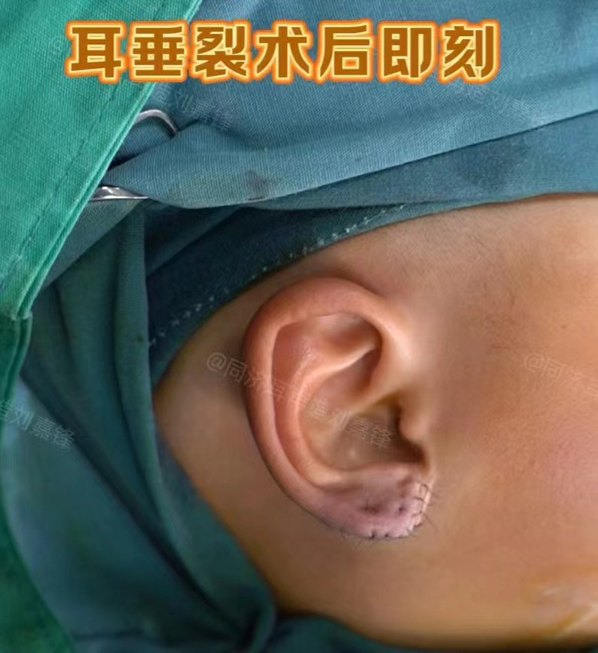 宝宝耳垂连起来了,妈妈说再也不会有人给他取外号了.