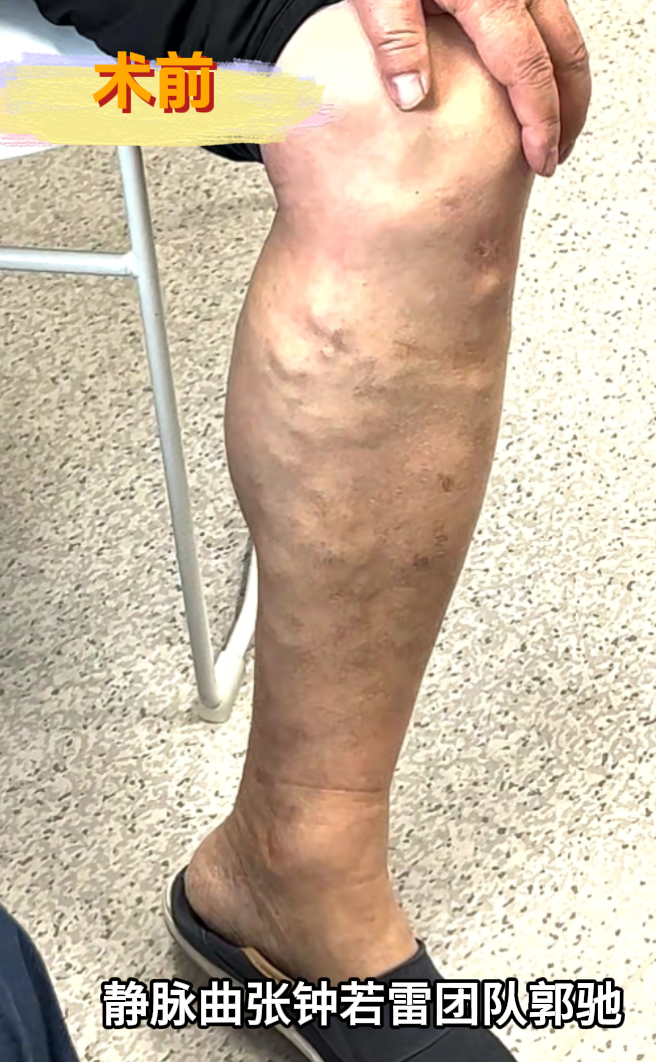 在网上关注武汉六医院血管外科很久了,看了很多案例,但是我之前一直