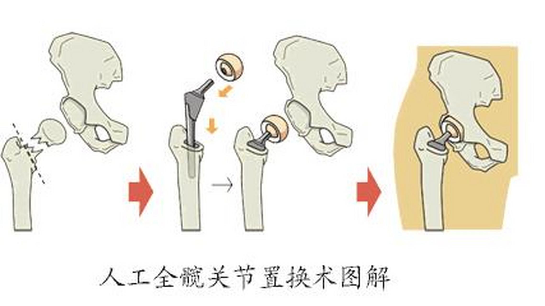 高龄老人置换成常规 新髋带您重获新生