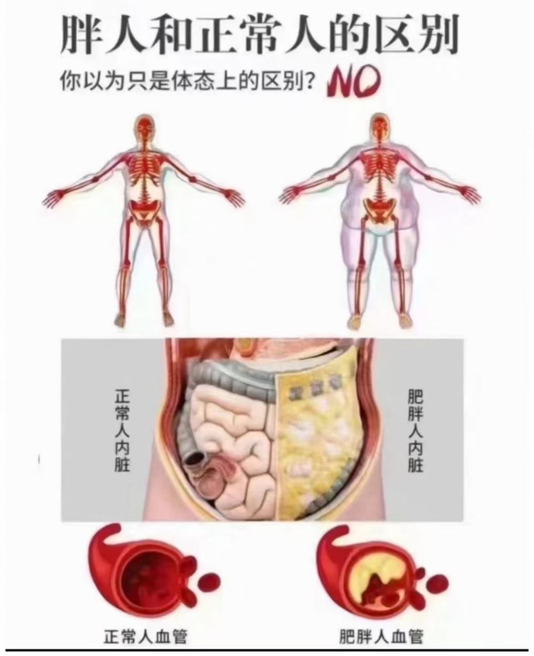 肥胖真正可怕的不是双下巴,也不是大肚腩,更不是穿不上漂亮小裙子!
