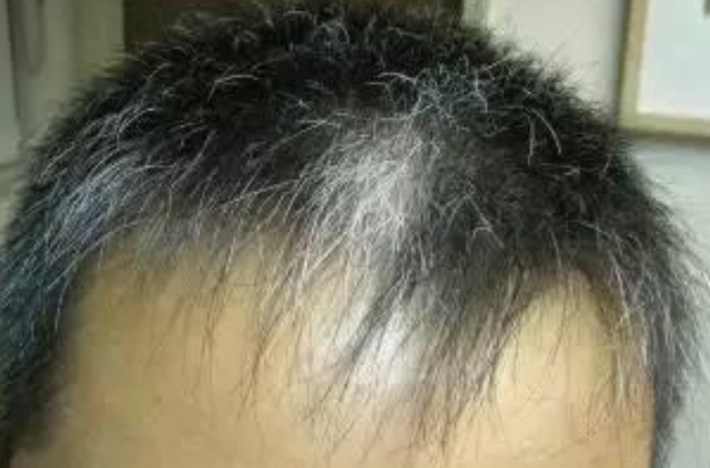 白发长在哪,病就从哪出?长在前额,两鬓,后脑勺,分别代表什么