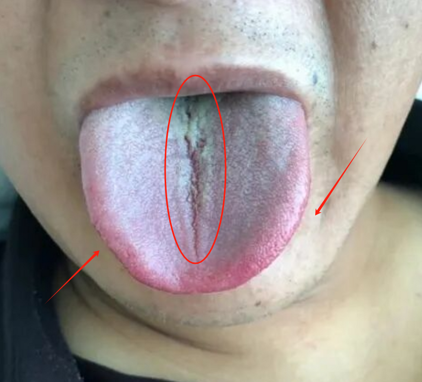 裂纹舌,脾胃虚弱,慢性胃炎患者到现在还不知道如何改善?