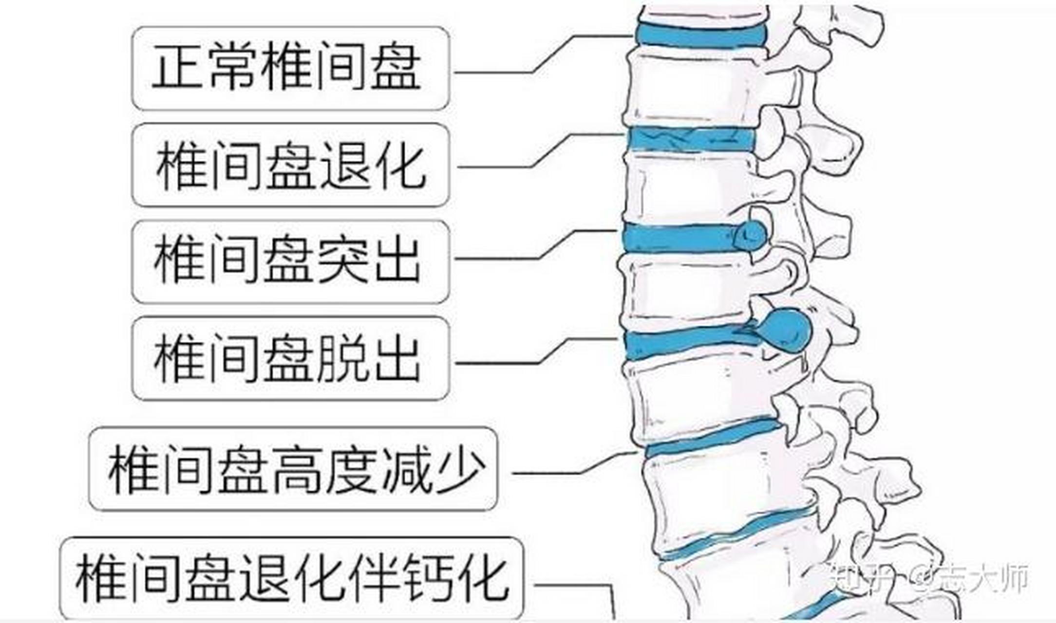 腰椎间盘位置结构图图片