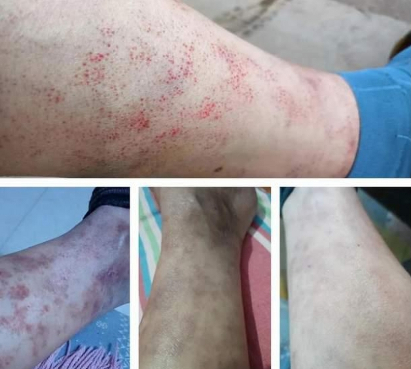 身体的3个"信号",或是血小板减少的迹象,切莫大意!  你有没有?