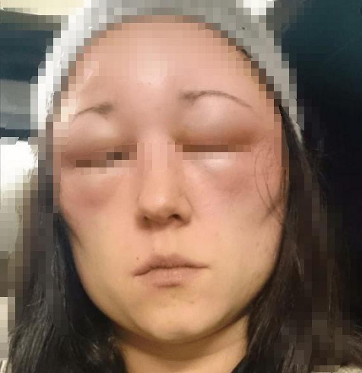 脸上若有这些浮肿,要警惕肾脏受损!