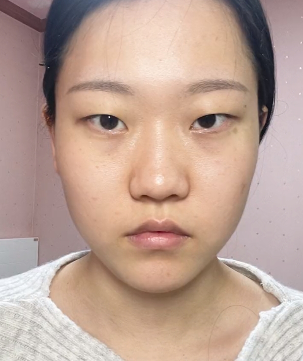 姑娘的鼻背偏宽,鼻头肥大,鼻翼组织肥厚,鼻头圆钝,鼻基底凹陷导致面