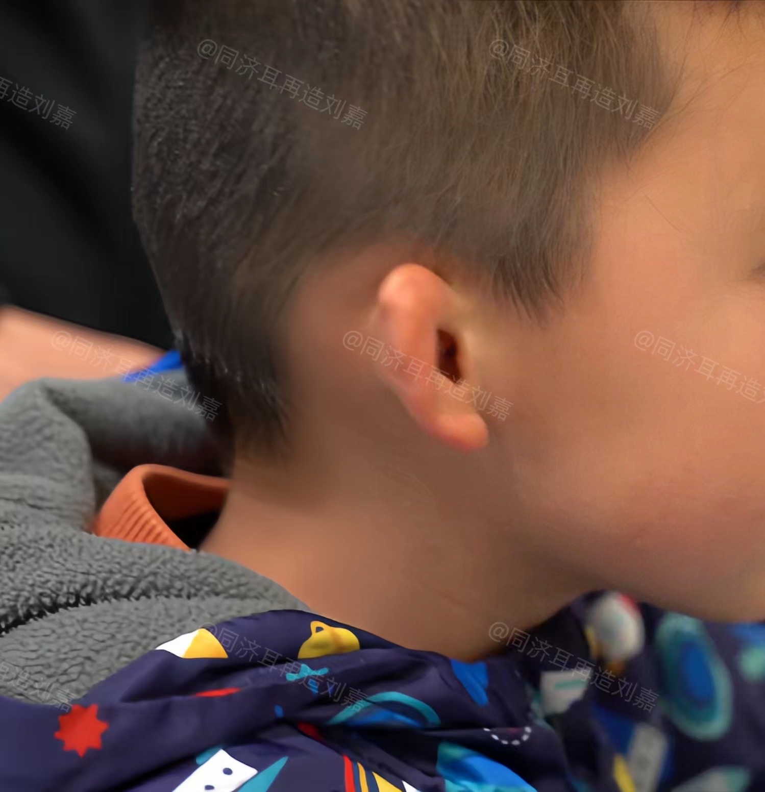 门诊上有个孩子耳朵是2度小耳畸形,耳朵大部分组织都在,如果做全包法