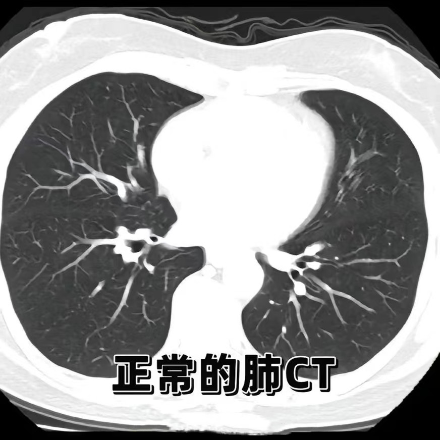 叶内型隔离肺图片