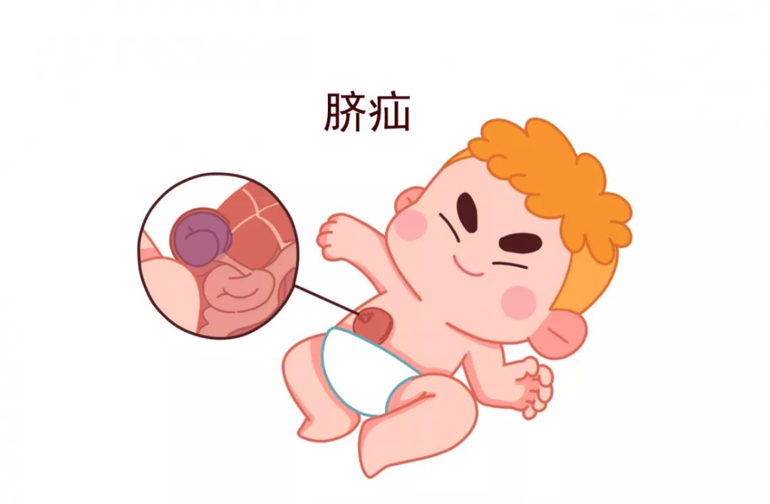 「科普」宝宝出现脐疝不担忧,无创脐疝护理来帮您