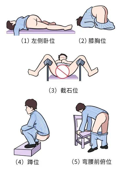 人类的肛门都塞过什么东西?(求求了,别再来为难医生了~)