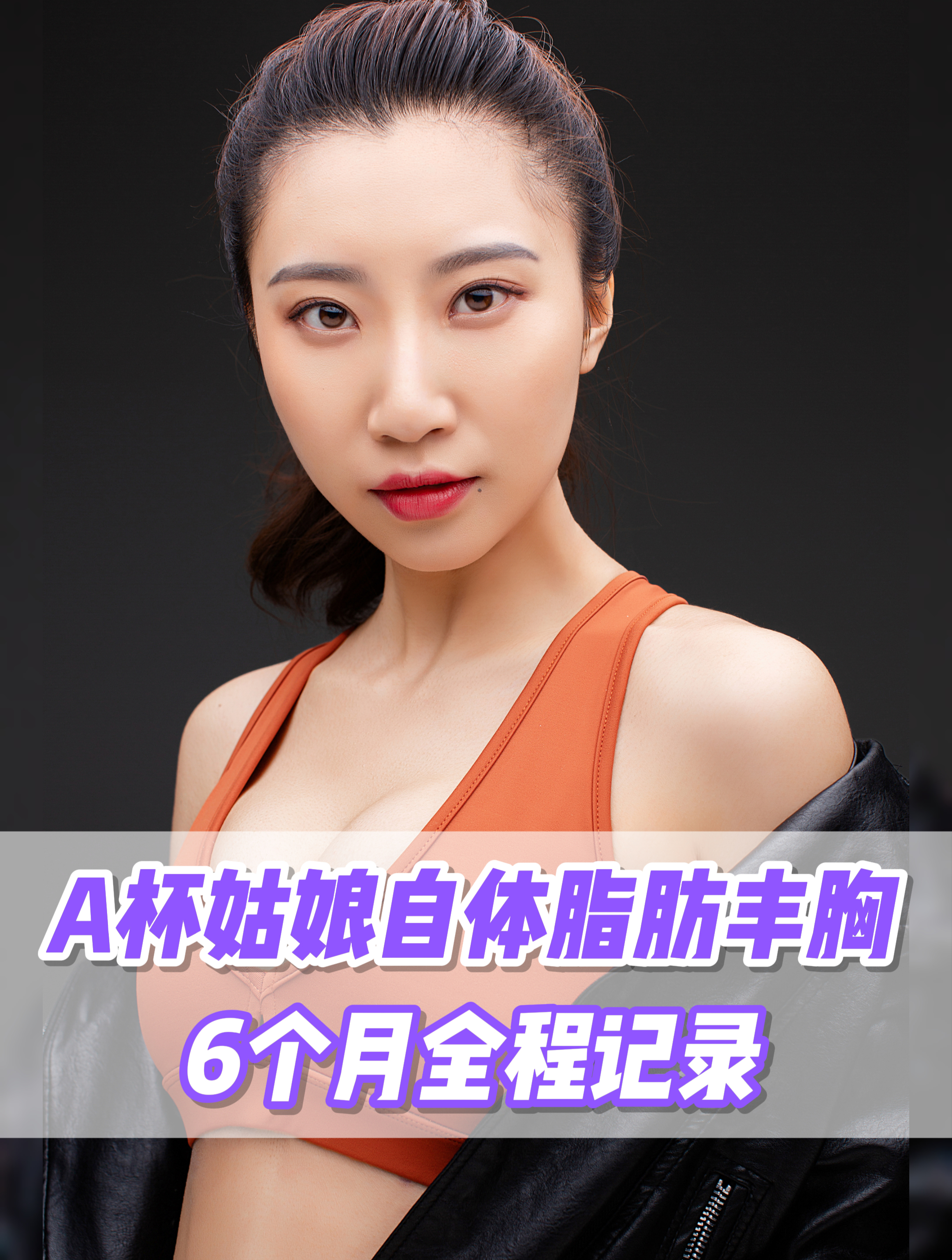 a杯姑娘自体脂肪丰胸术后6个月全程记录:又饱满又柔软!