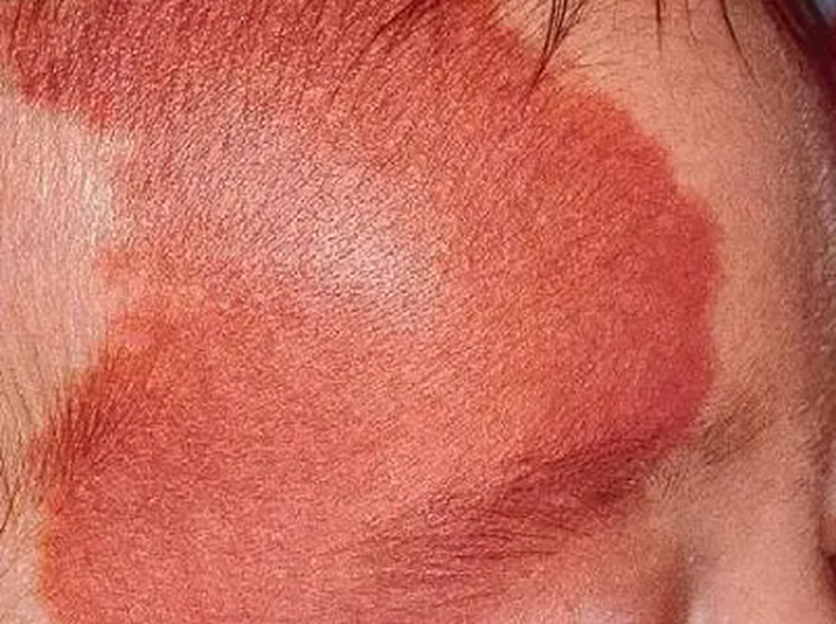 家长关注—宝宝身上的红胎记,会自动消失吗?