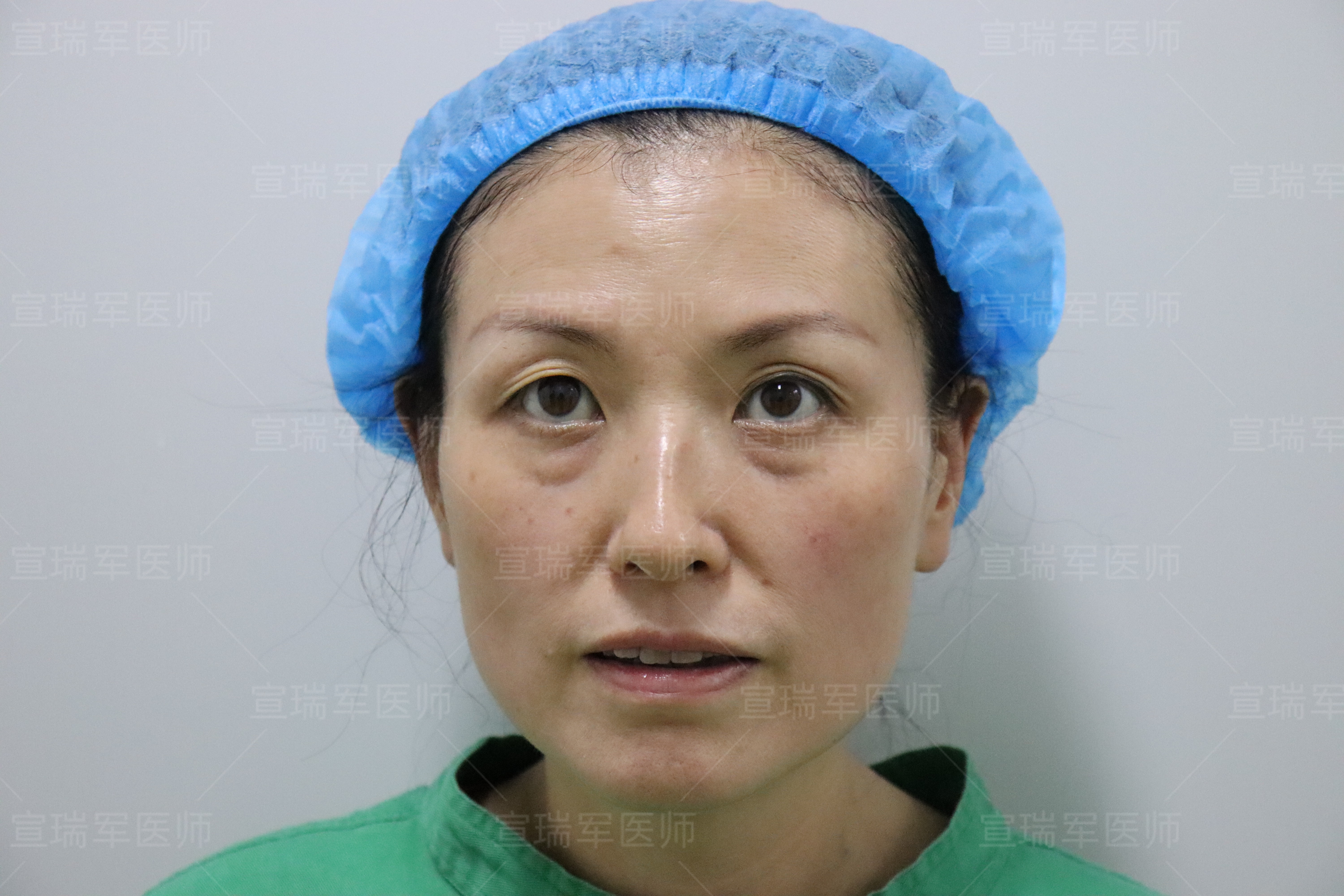 患者不仅是眼袋膨出明显,泪沟凹陷的问题也很明显,但眼部皮肤通过