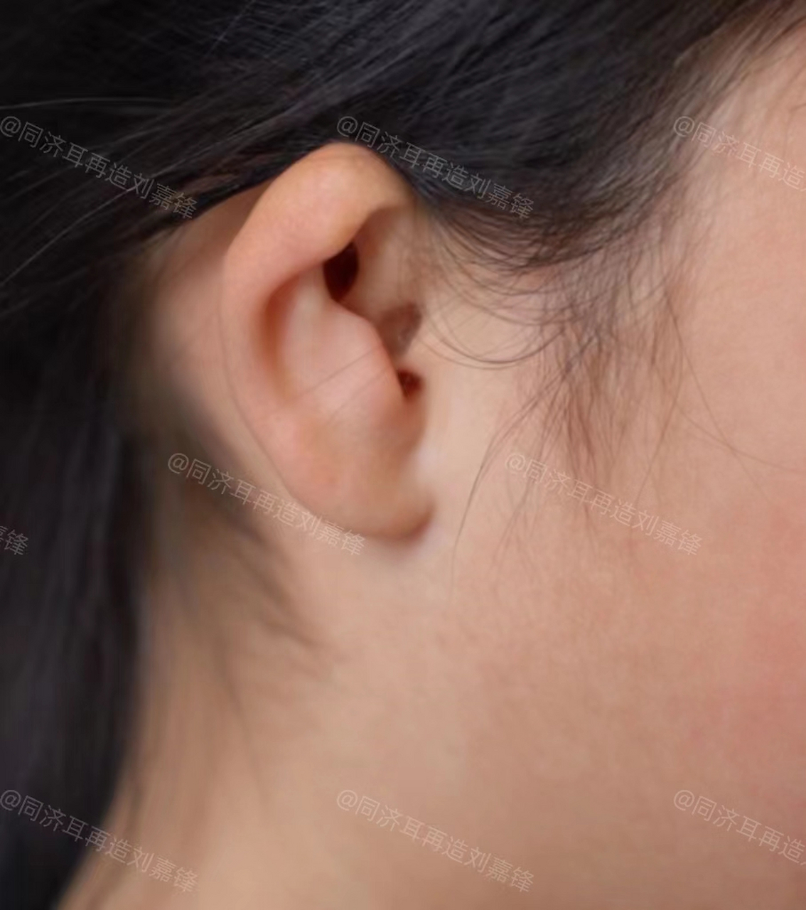 "  这个11岁女孩小耳畸形,妈妈想要趁着孩子还比较小的时候就把耳朵给