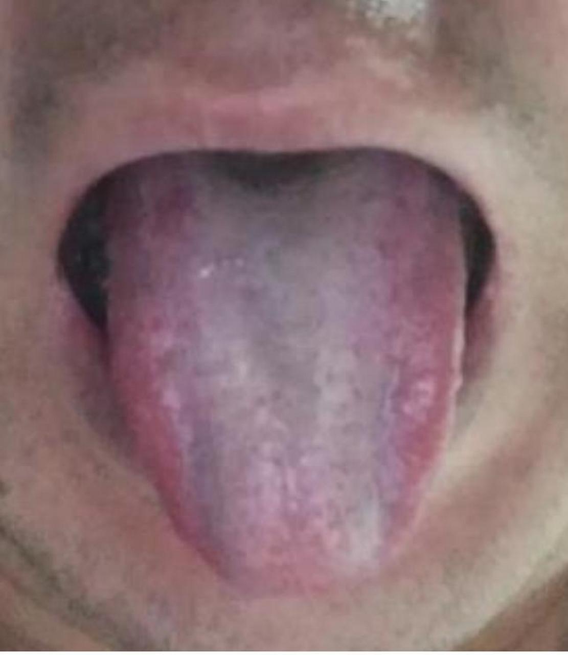 这是因很多原发性的肝癌舌象里多会出现这两条肝瘿线,这个发现是在