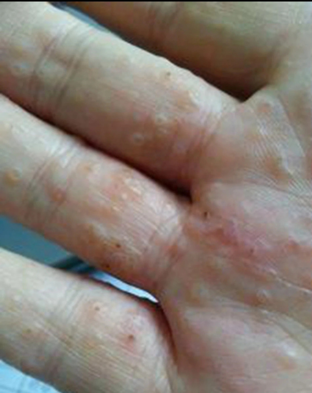 我的手这几天净长这些小泡泡,特别痒,越挠越痒,越痒越想挠,去医院看了