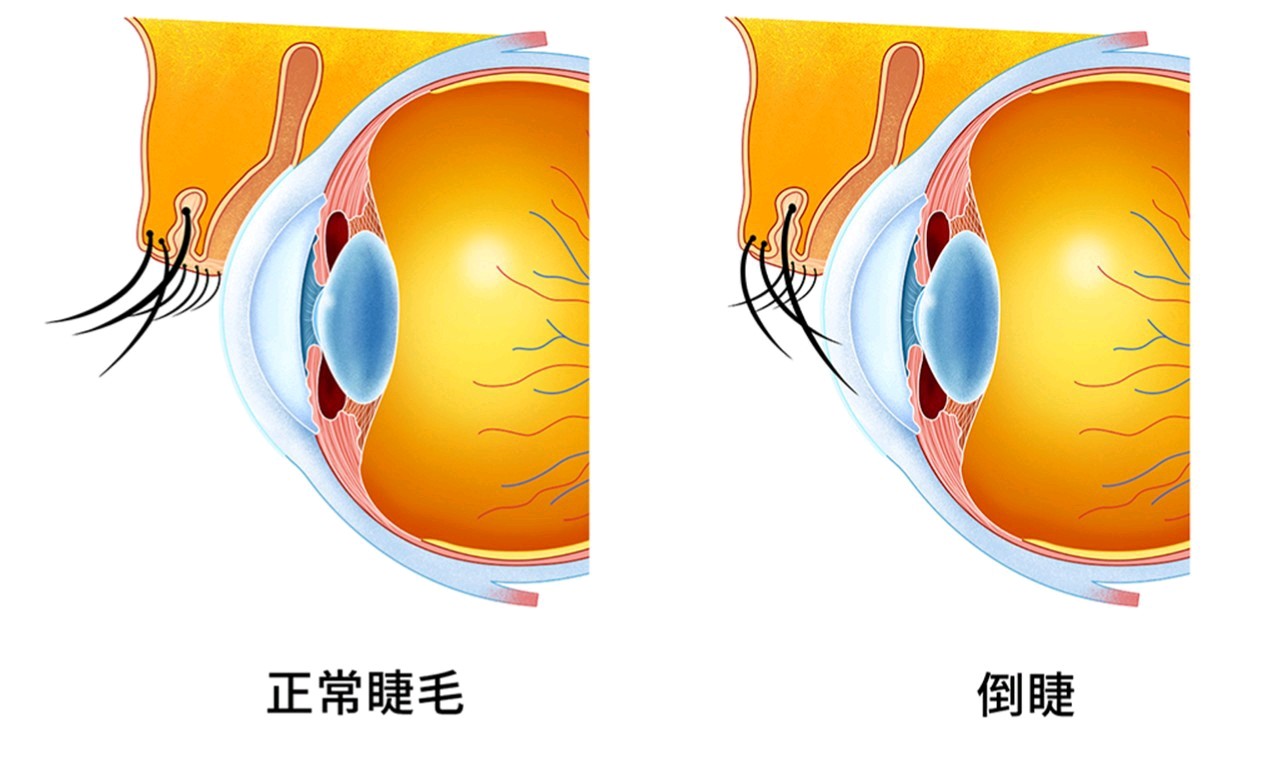 睫脊反射图片