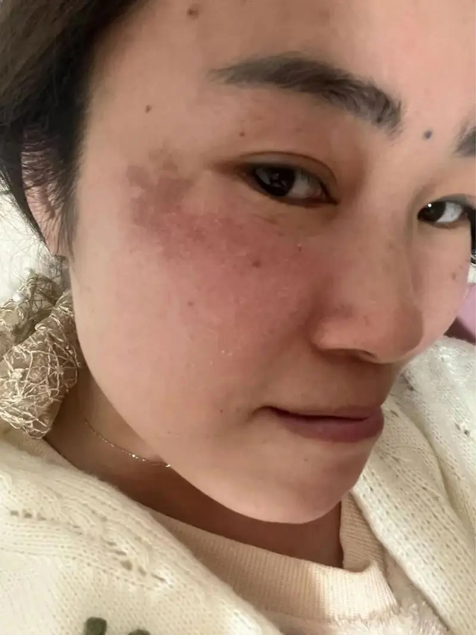 如果你现在满足这些条件,小心黄褐斑突袭!  1.年龄在35-55岁的  2.